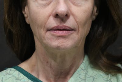 Facelift Before & After Gallery - Patient 315264 - Image 1