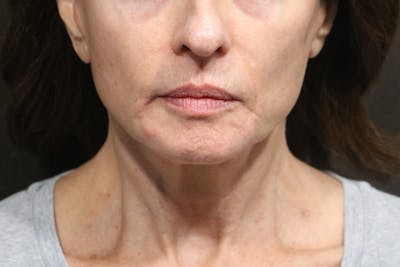 Facelift Before & After Gallery - Patient 315264 - Image 2