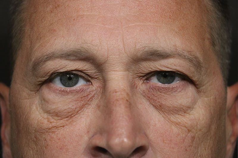 Eyelid Before & After Gallery - Patient 657171 - Image 1