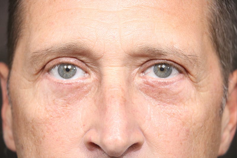 Eyelid Before & After Gallery - Patient 657171 - Image 2