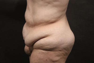 Tummy Tuck Before & After Gallery - Patient 892166 - Image 1