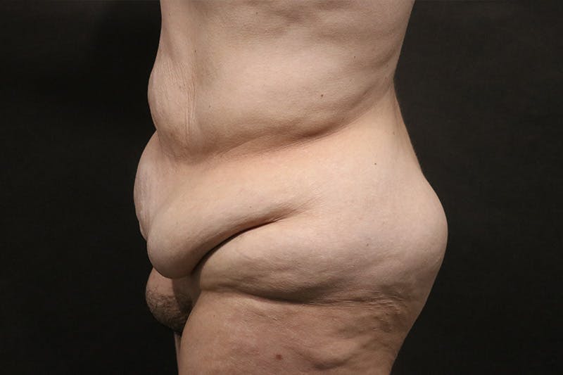 Tummy Tuck Before & After Gallery - Patient 892166 - Image 1