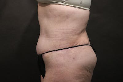 Tummy Tuck Before & After Gallery - Patient 892166 - Image 2