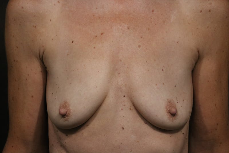 Breast Augmentation Before & After Gallery - Patient 406493 - Image 1