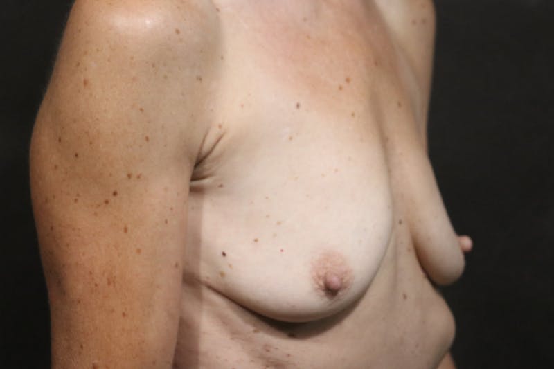 Breast Augmentation Before & After Gallery - Patient 406493 - Image 3