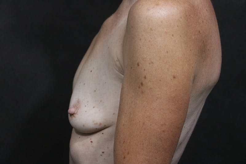 Breast Augmentation Before & After Gallery - Patient 406493 - Image 5