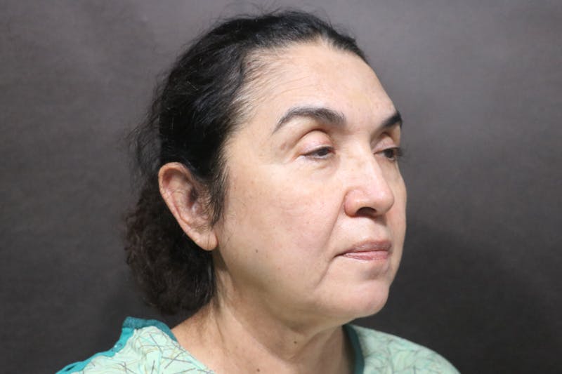 Facelift Before & After Gallery - Patient 100309 - Image 1