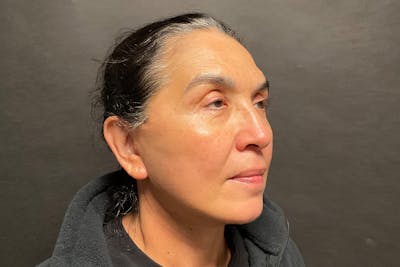 Facelift Before & After Gallery - Patient 100309 - Image 2