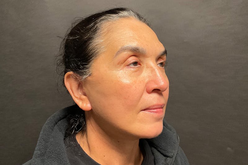 Facelift Before & After Gallery - Patient 100309 - Image 2
