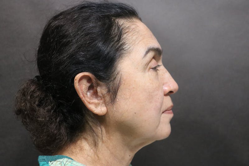 Facelift Before & After Gallery - Patient 100309 - Image 3