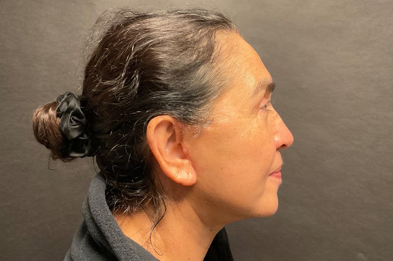 Facelift Before & After Gallery - Patient 100309 - Image 4