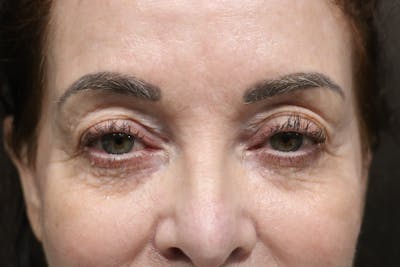 Eyelid Before & After Gallery - Patient 352441 - Image 1