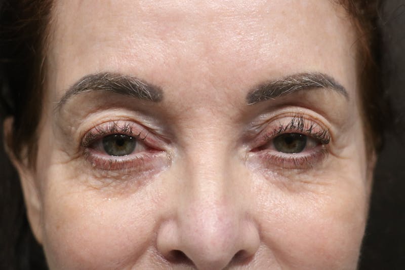Eyelid Before & After Gallery - Patient 352441 - Image 1