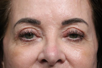 Eyelid Before & After Gallery - Patient 352441 - Image 2