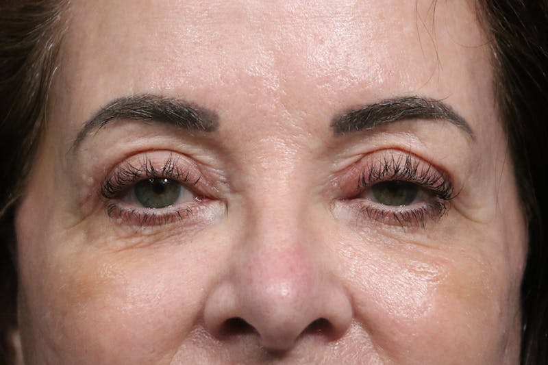 Eyelid Before & After Gallery - Patient 352441 - Image 2