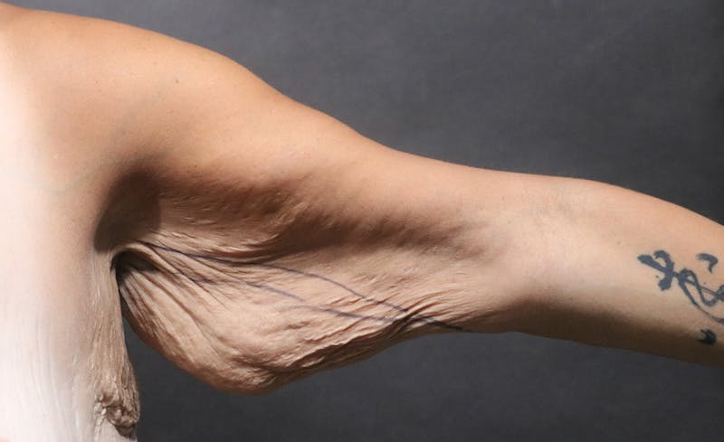 Arm Lift Before & After Gallery - Patient 392044 - Image 1