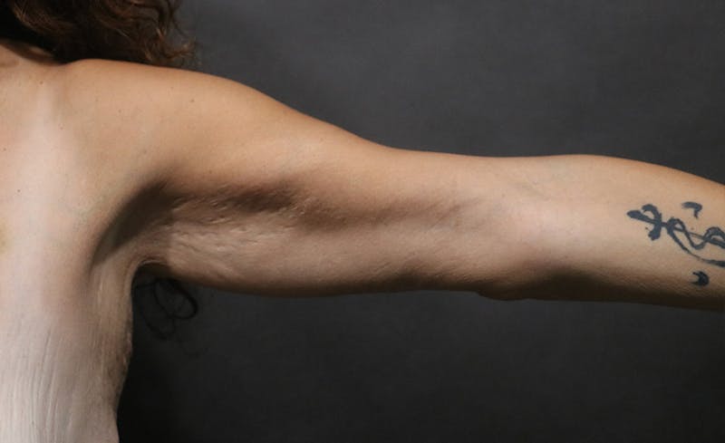 Arm Lift Before & After Gallery - Patient 392044 - Image 2
