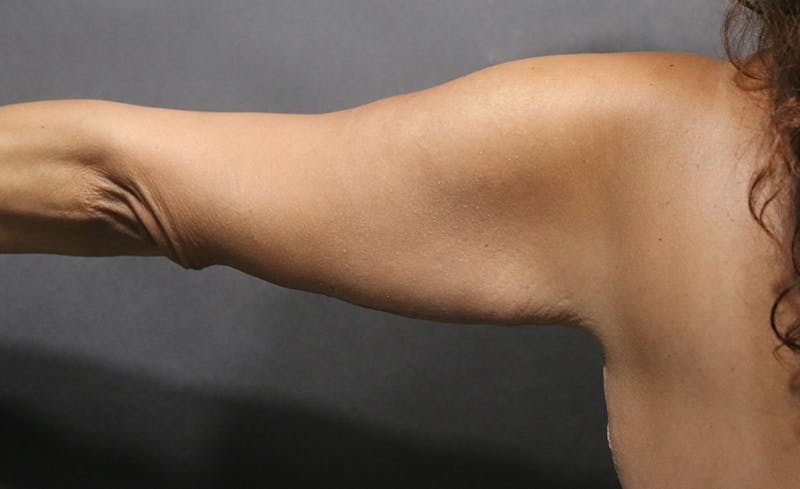 Arm Lift Before & After Gallery - Patient 392044 - Image 6
