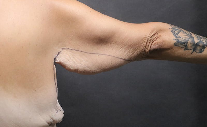 Arm Lift Before & After Gallery - Patient 392044 - Image 3