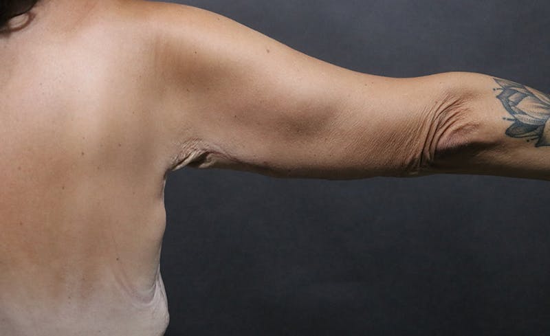 Arm Lift Before & After Gallery - Patient 392044 - Image 4