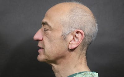 Neck Lift Before & After Gallery - Patient 199563 - Image 1