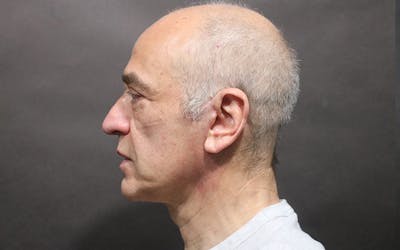 Neck Lift Before & After Gallery - Patient 199563 - Image 2