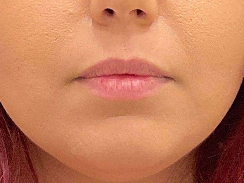 Restylane Before & After Gallery - Patient 317844 - Image 1