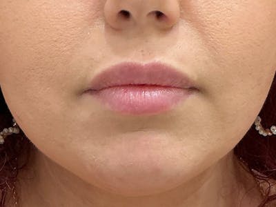 Restylane Before & After Gallery - Patient 317844 - Image 2