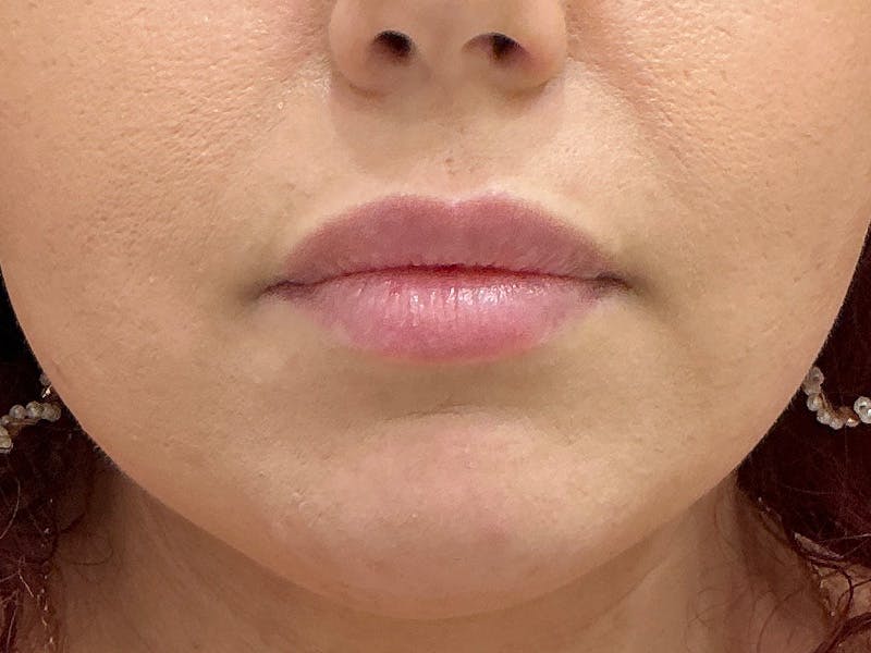 Restylane Before & After Gallery - Patient 317844 - Image 2