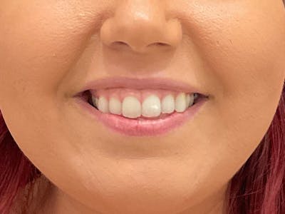 Botox / Dysport Before & After Gallery - Patient 508166 - Image 1