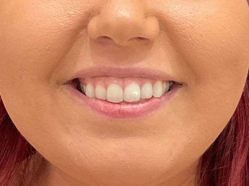 Botox / Dysport Before & After Gallery - Patient 508166 - Image 1