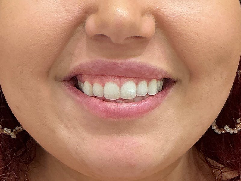 Botox / Dysport Before & After Gallery - Patient 508166 - Image 2