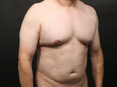 Renuvion Before & After Gallery - Patient 386499 - Image 1