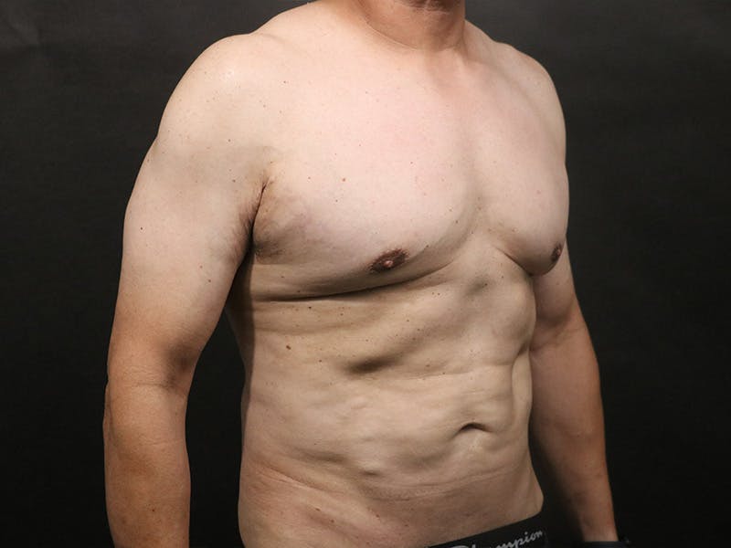 Renuvion Before & After Gallery - Patient 386499 - Image 2