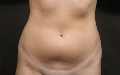 Liposuction Before & After Gallery - Patient 476669 - Image 1
