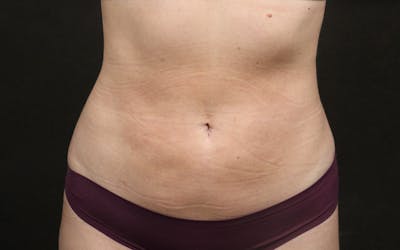 Liposuction Before & After Gallery - Patient 476669 - Image 2