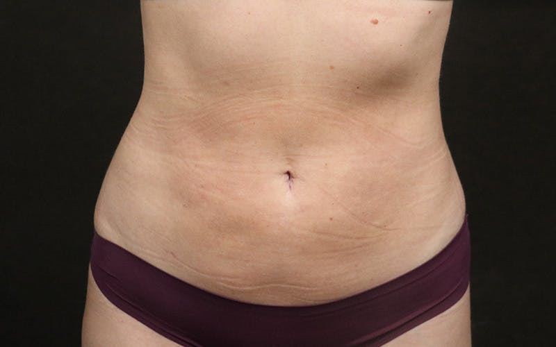Liposuction Before & After Gallery - Patient 476669 - Image 2
