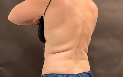 CoolSculpting Before & After Gallery - Patient 182561 - Image 1