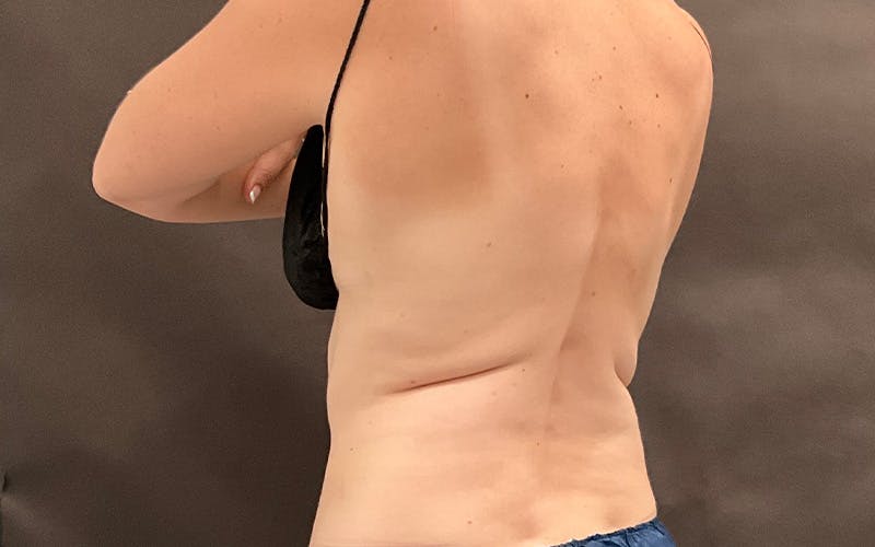 CoolSculpting Before & After Gallery - Patient 182561 - Image 2