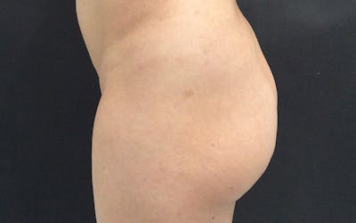 Sculptra Before & After Gallery - Patient 652054 - Image 1