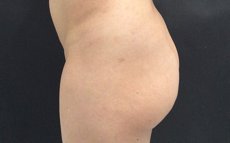 Sculptra Before & After Gallery - Patient 652054 - Image 1