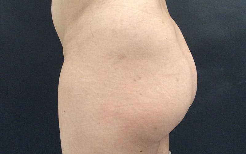 Sculptra Before & After Gallery - Patient 652054 - Image 2