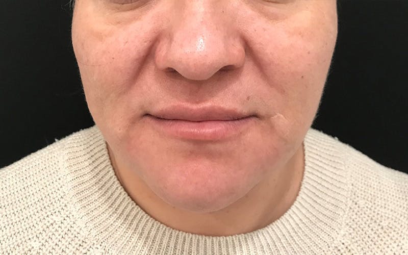 Morpheus8 Before & After Gallery - Patient 402744 - Image 1