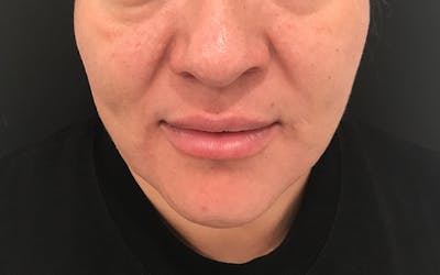 Morpheus8 Before & After Gallery - Patient 402744 - Image 2