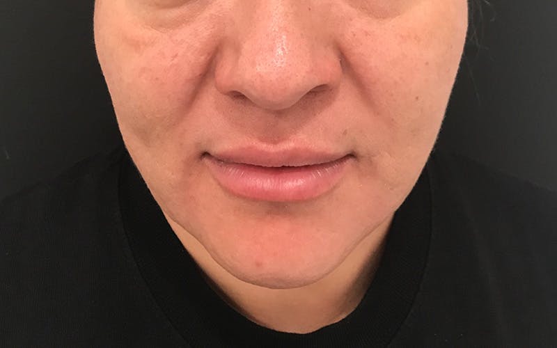 Morpheus8 Before & After Gallery - Patient 402744 - Image 2