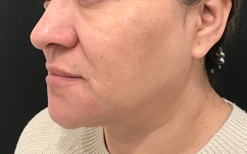 Morpheus8 Before & After Gallery - Patient 402744 - Image 3