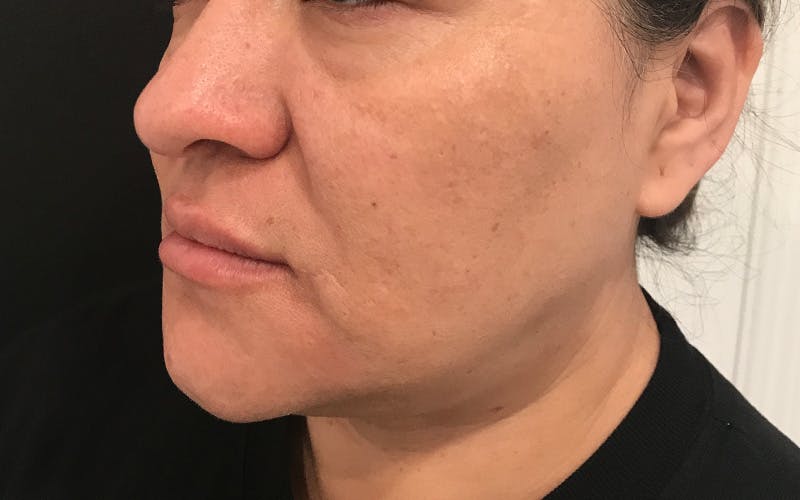 Morpheus8 Before & After Gallery - Patient 402744 - Image 4