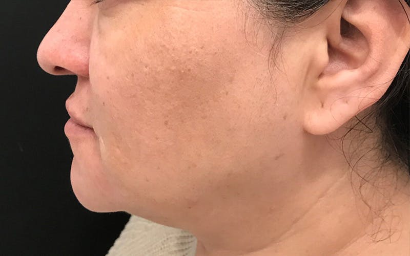 Morpheus8 Before & After Gallery - Patient 402744 - Image 5