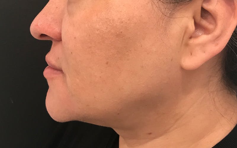 Morpheus8 Before & After Gallery - Patient 402744 - Image 6