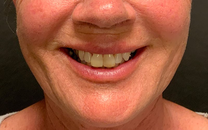 Juvederm / Voluma / Volbella / Kybella Before & After Gallery - Patient 189250 - Image 3